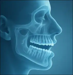 تشخیص سینوزیت قارچی مهاجم با استفاده از تصویربرداری CBCT در بیمار مبتلا به دیابت