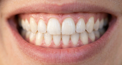 بررسی تنوعات آناتومیکی عصبی‌ـ‌عروقی در ناحیه قدامی فک بالا با استفاده از تصاویر CBCT
