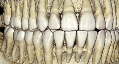 بررسی ارتباط ویژگی‌های کانال گابرناکولار با وضعیت رویش دندان‌ها در تصاویر CBCT