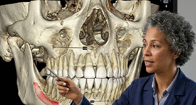 یافته‌های CBCT در تشخیص سینوزیت قارچی پس از ابتلا به کووید ۱۹
